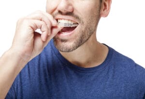 Invisalign and sports: can athletes wear aligners?