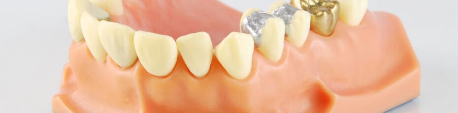 Composite Fillings in NW Calgary