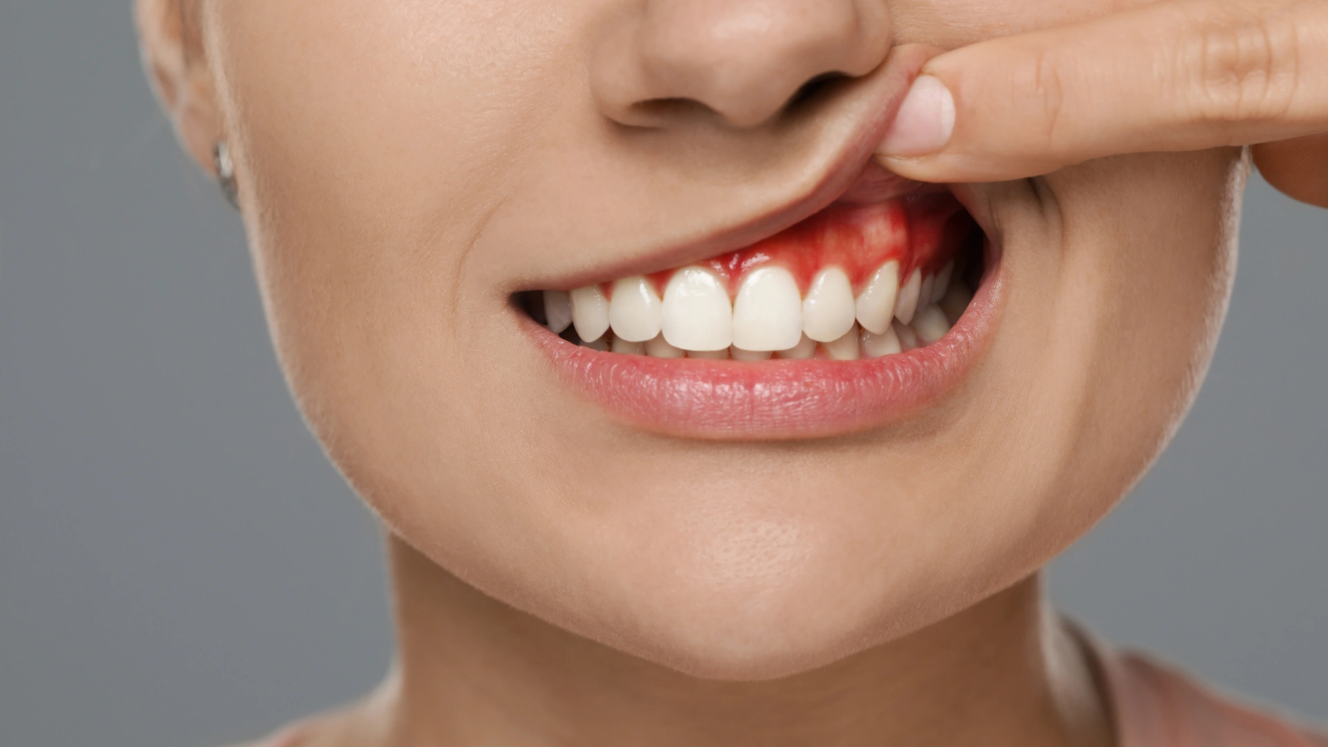 Gingivitis