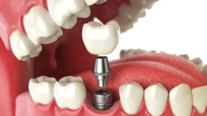 Dental Implants Calgary
