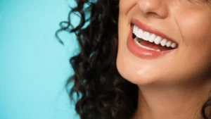 Veneers