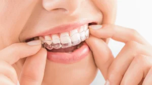 Invisalign Aligners