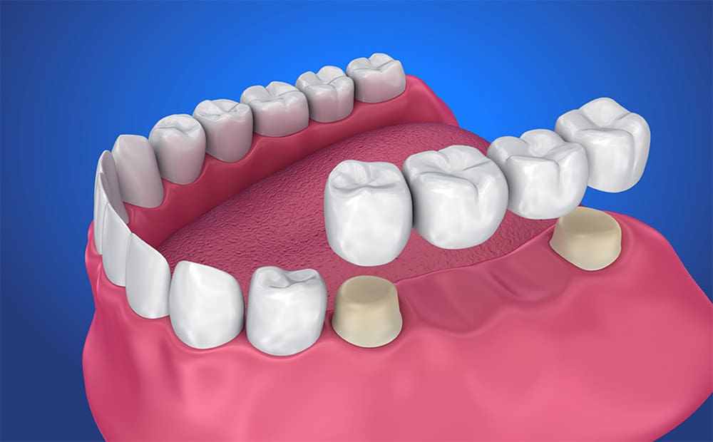 dental-bridges-nw-calgary