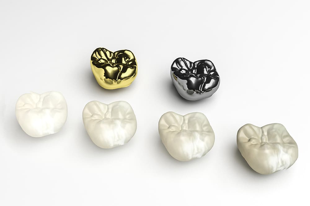 dental-crowns-nw-calgary