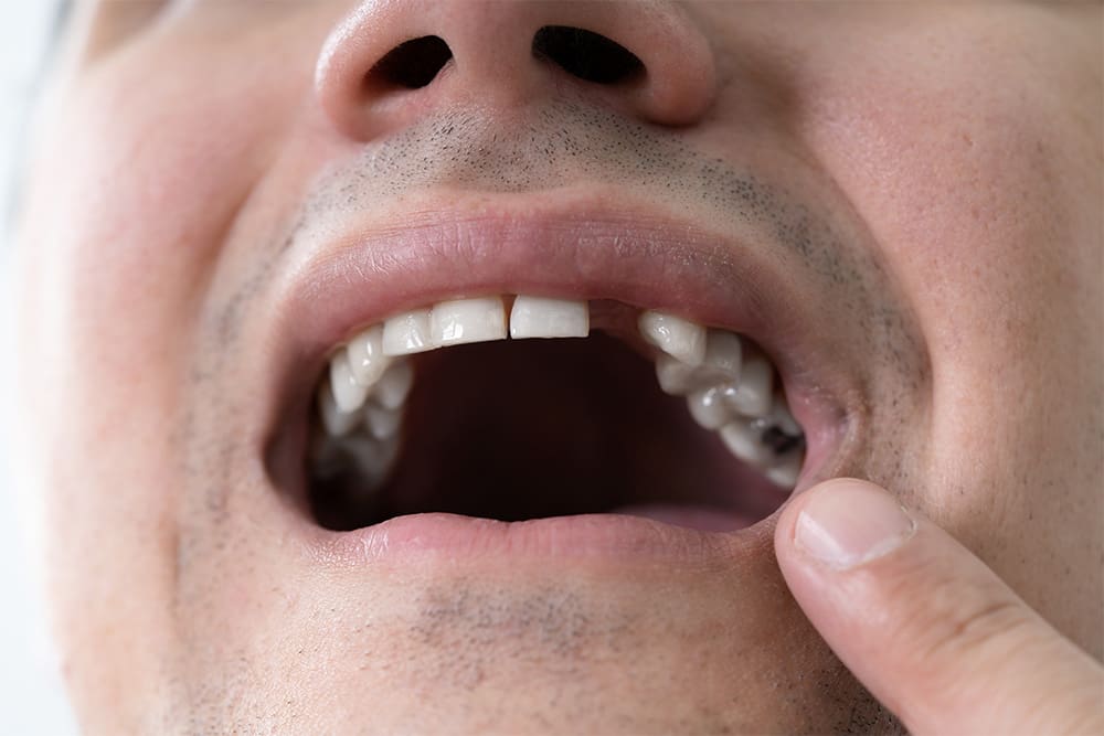 tooth-extractions-nw-calgary