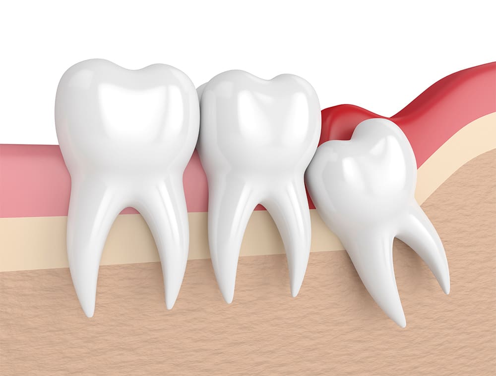 wisdom-teeth-extraction-nw-calgary