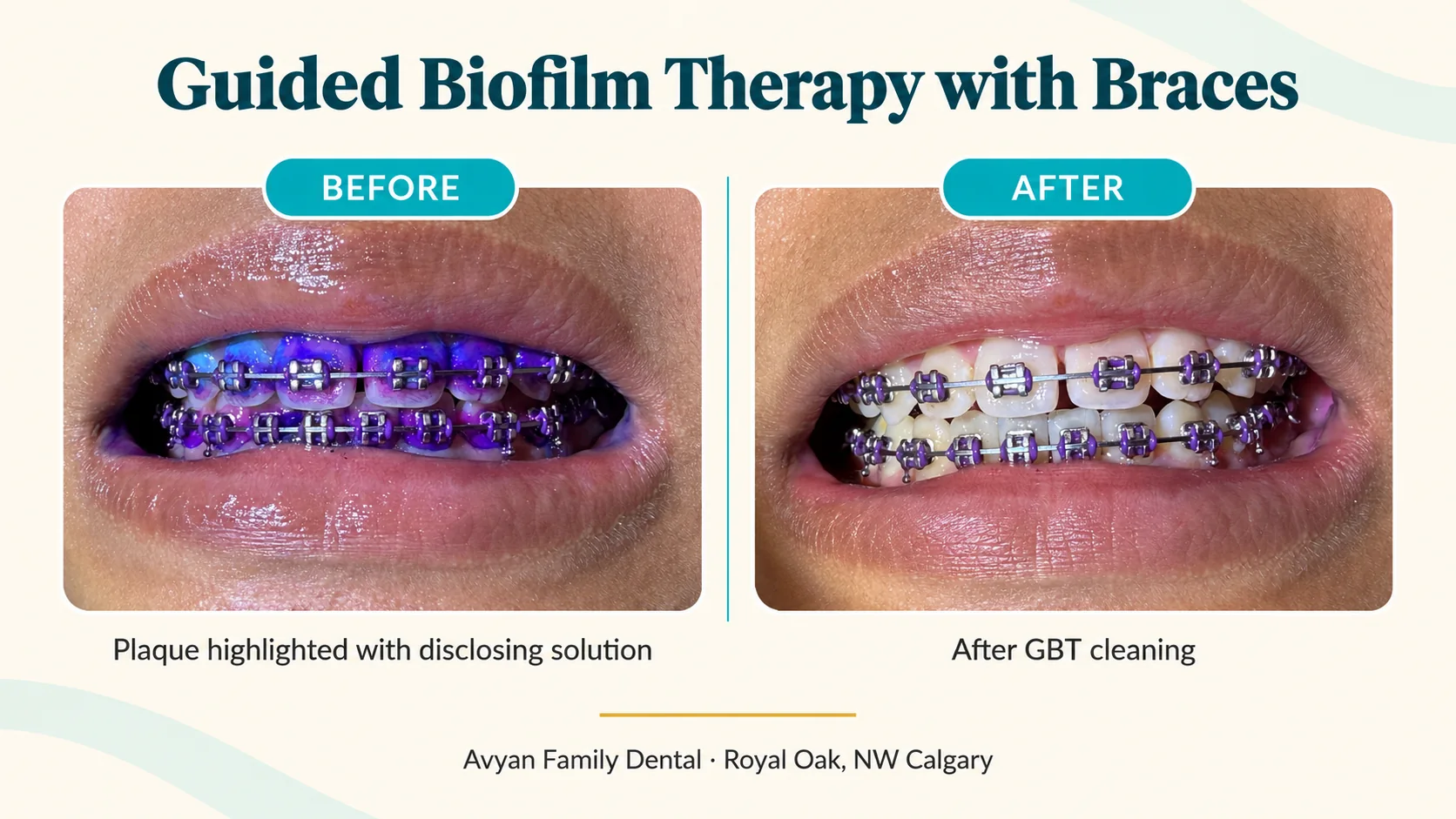 Before and after Guided Biofilm Therapy on a patient with braces: plaque shown in purple by disclosing solution, then clean teeth after GBT at Avyan Family Dental, NW Calgary